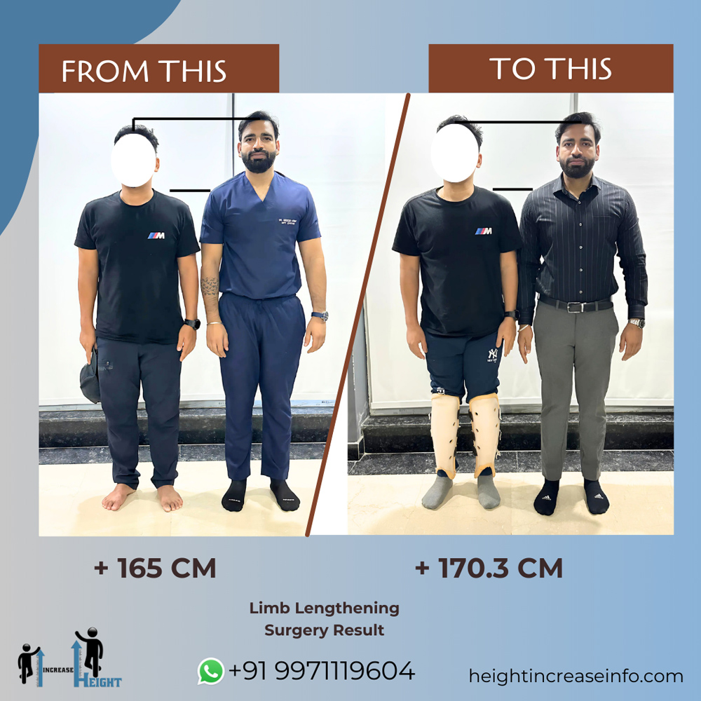 Limb Lengthening Result 1